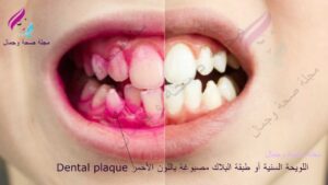 Dental plaque طبقة البلاك أو اللويحة السنية - تنظيف الأسنان