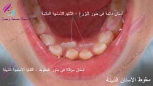 ظهور الأسنان الدائمة خلف اللبنية