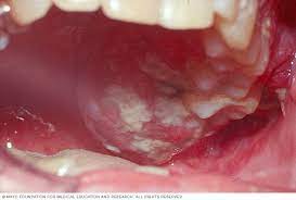 Photo of كانسر الفم أو سرطان الفم والآفات السرطانية