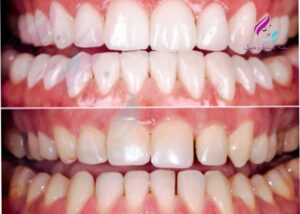 وصفات طبيعية تبييض الاسنان
