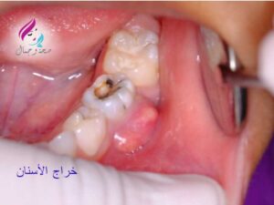 علاج خراج الاسنان المزمن
