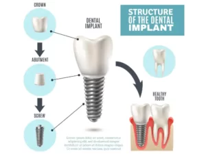 إزالة العنصر: dental implant Cost in Turkey dental implant Cost in Turkey