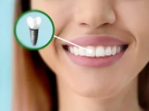Tooth implant Cost in Turkey