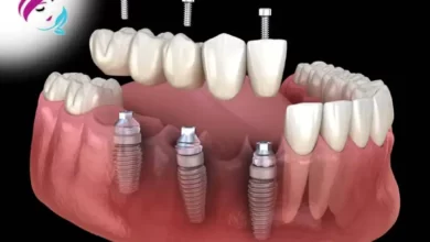 Photo of Tooth implant Cost in Turkey 2022