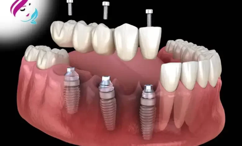 Tooth implant Cost in Turkey