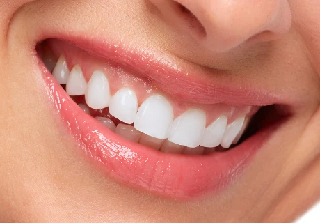 How Much Does a Full Set of Veneers Cost in Turkey
