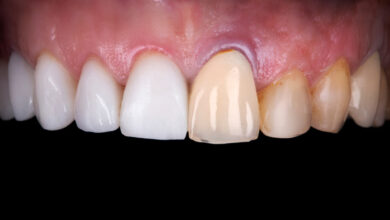 Photo of Zirconium Dental Work in Turkey – ترکیب اسنان زيركون في تركيا