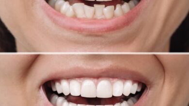 Photo of Dental Veneers in Turkey: A Perfect Smile Solutio