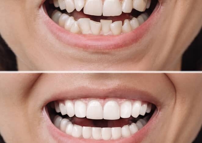 Dental-Veneers-in-Turkey-perfect-smile