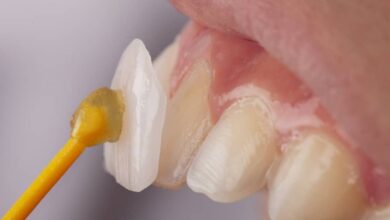 Photo of How long does the dental veneer procedure typically take in Turkey?