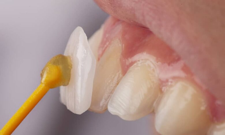How long does the dental veneer procedure typically take in Turkey