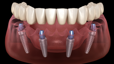 Photo of Restore Your Smile and Confidence with All-on-4 Dental Implants in Istanbul